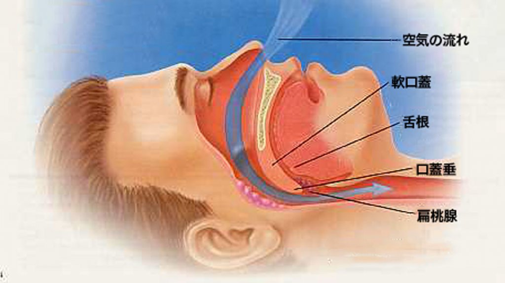 睡眠中の正常な状態の上気道の図。いっぽう睡眠呼吸障害は、舌が喉の奥に沈下し呼吸が止まったり、止まりかけたりする状態となる